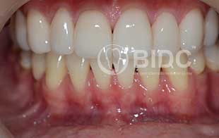 Full Upper Arch Crowns