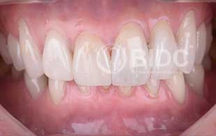 Full Mouth Rehabilitation Full Mouth Rehabilitation