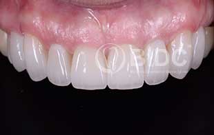 Full Mouth Veneers