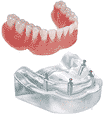 overdenture